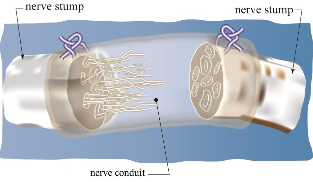 Peripheral Nerve Repair